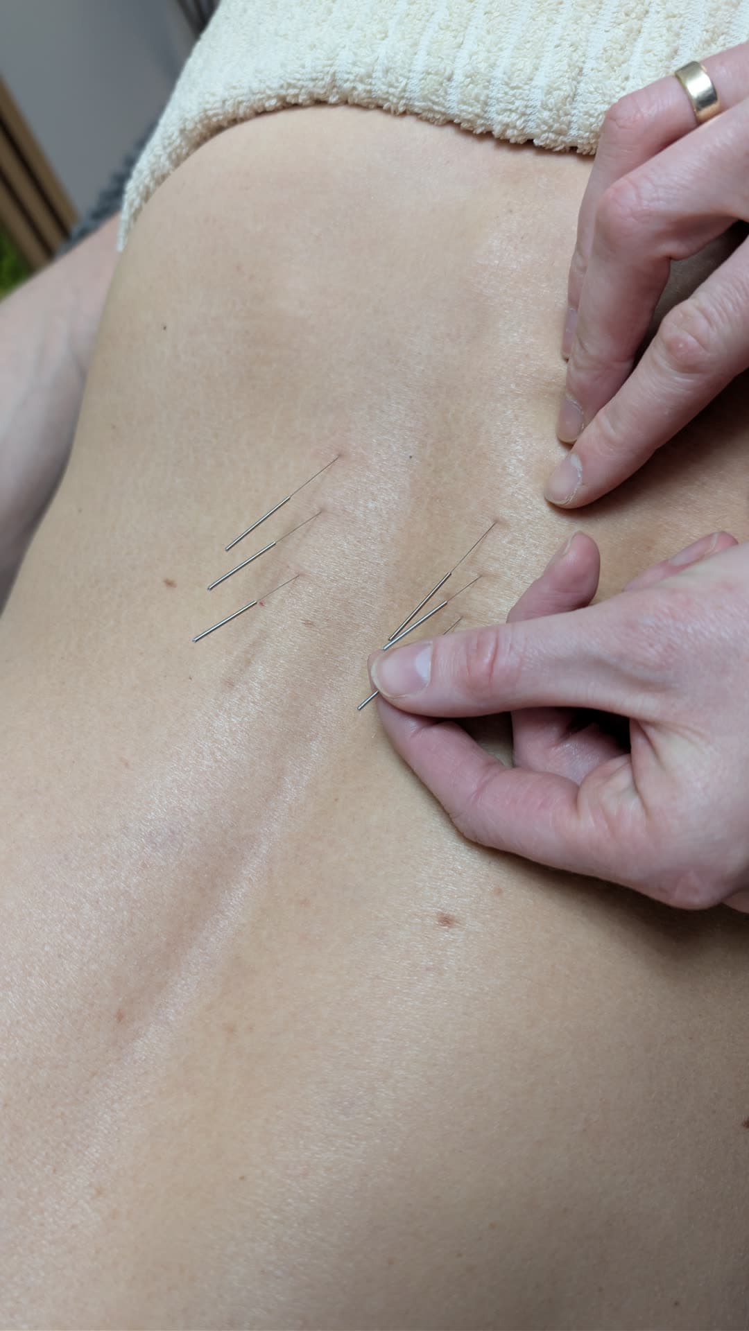 Suche igłowanie (dry needling) — zdjęcie