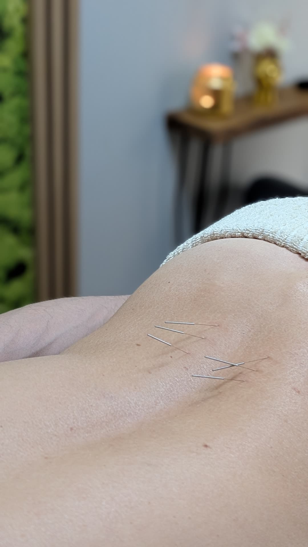 Suche igłowanie (dry needling) — zdjęcie